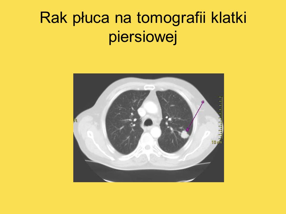 Rak płuca na tomografii klatki piersiowej