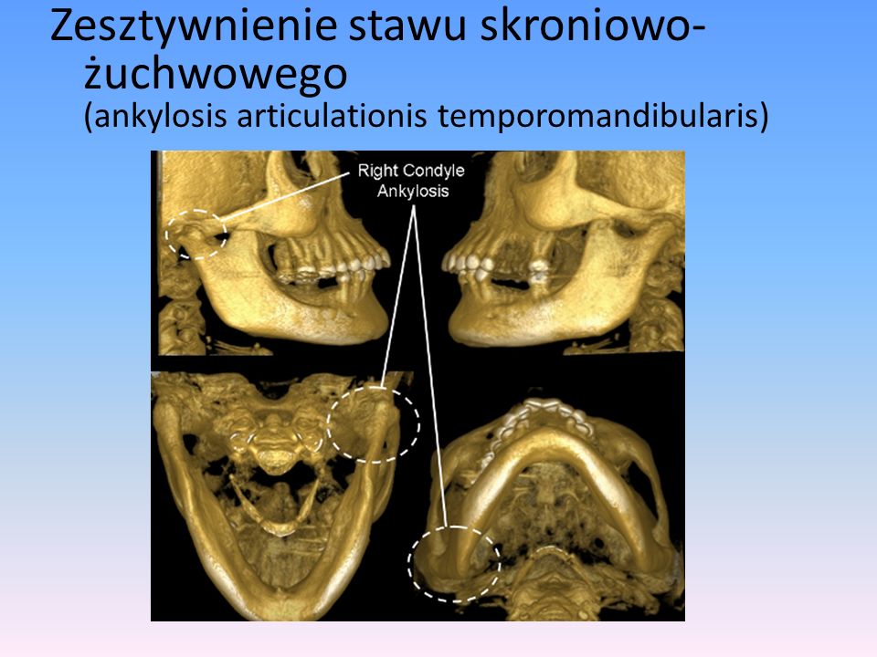 Zesztywnienie stawu skroniowo-żuchwowego (ankylosis articulationis temporomandibularis)