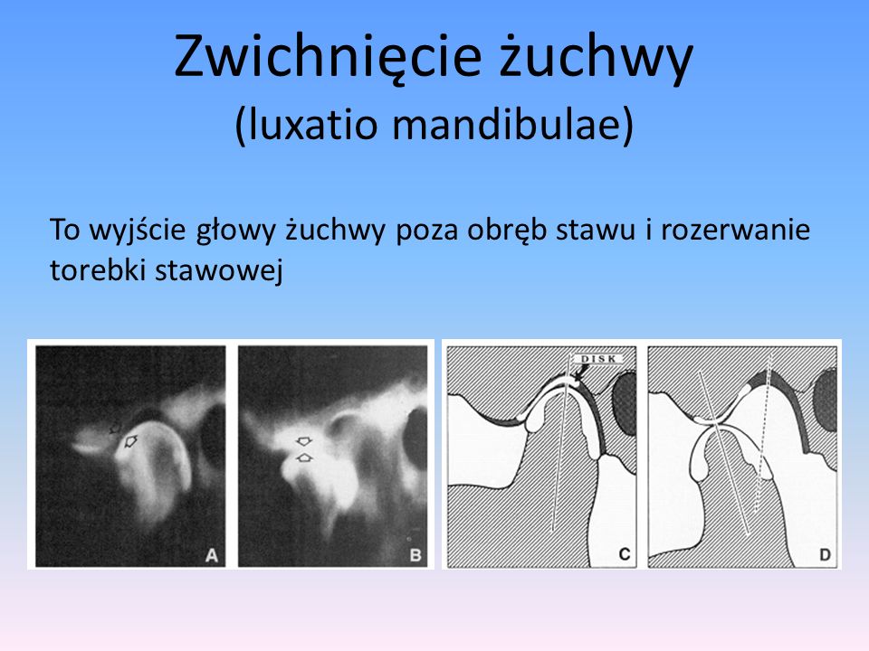 Zwichnięcie żuchwy (luxatio mandibulae)