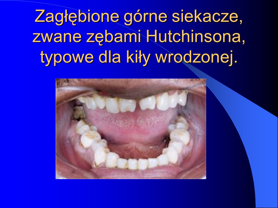 Zagłębione górne siekacze, zwane zębami Hutchinsona, typowe dla kiły wrodzonej.