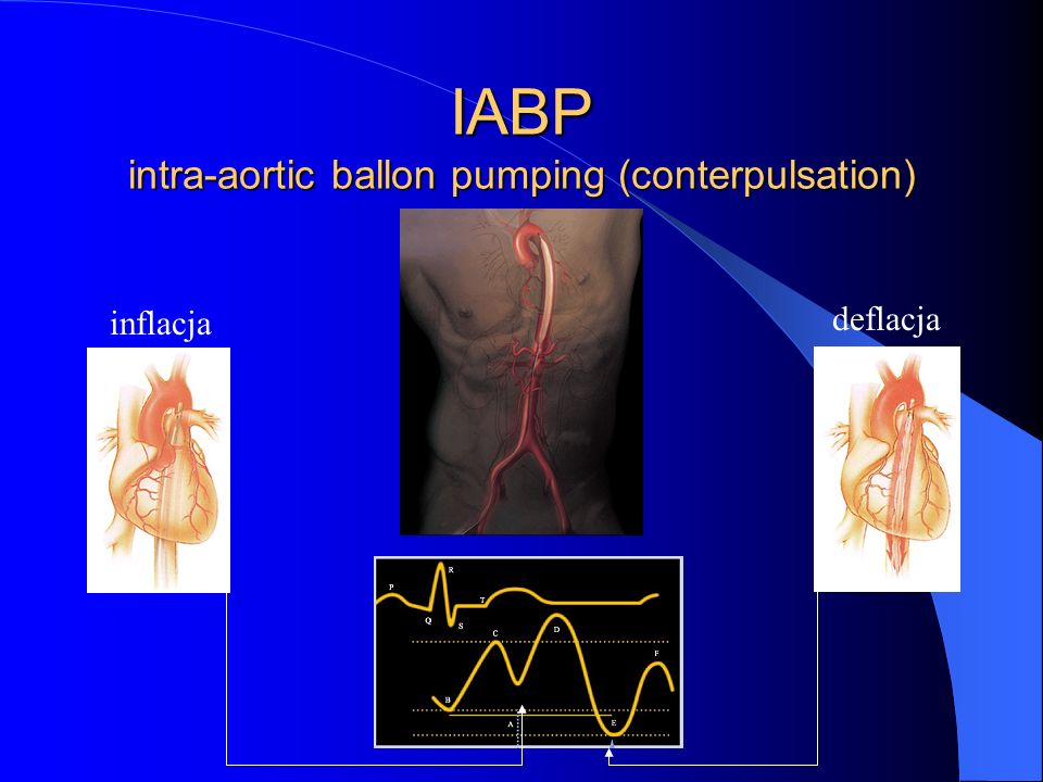 IABP intra-aortic ballon pumping (conterpulsation)