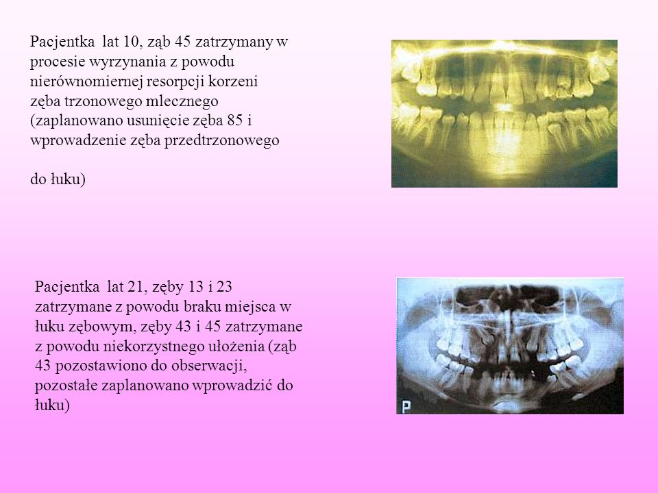 Pacjentka lat 10, ząb 45 zatrzymany w procesie wyrzynania z powodu nierównomiernej resorpcji korzeni zęba trzonowego mlecznego (zaplanowano usunięcie zęba 85 i wprowadzenie zęba przedtrzonowego do łuku)