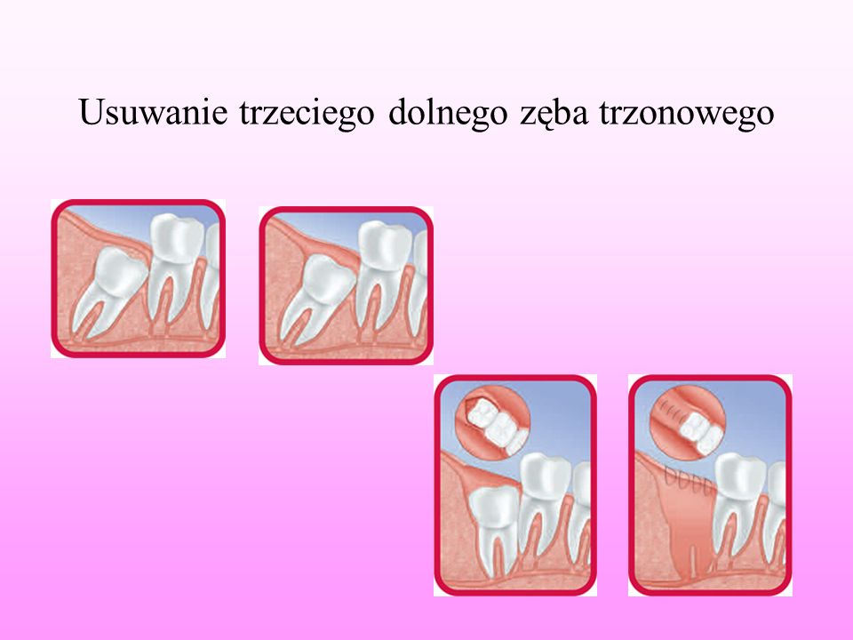 Usuwanie trzeciego dolnego zęba trzonowego