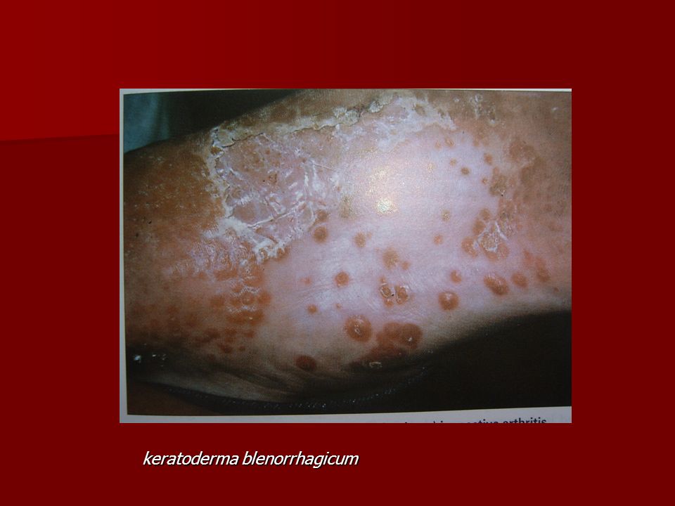 keratoderma blenorrhagicum