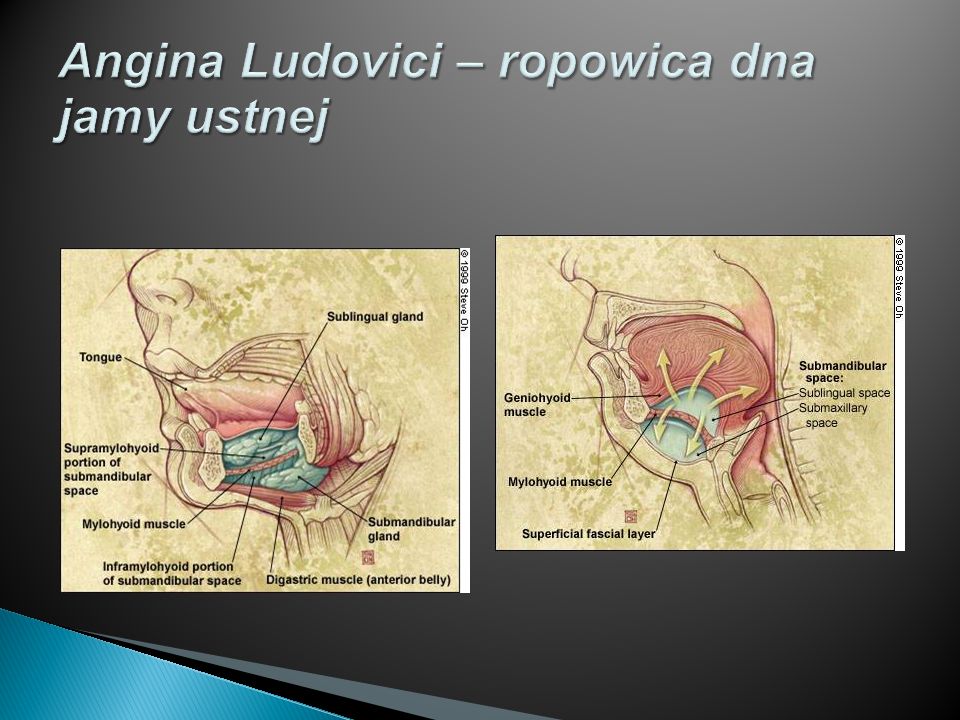 Angina Ludovici – ropowica dna jamy ustnej