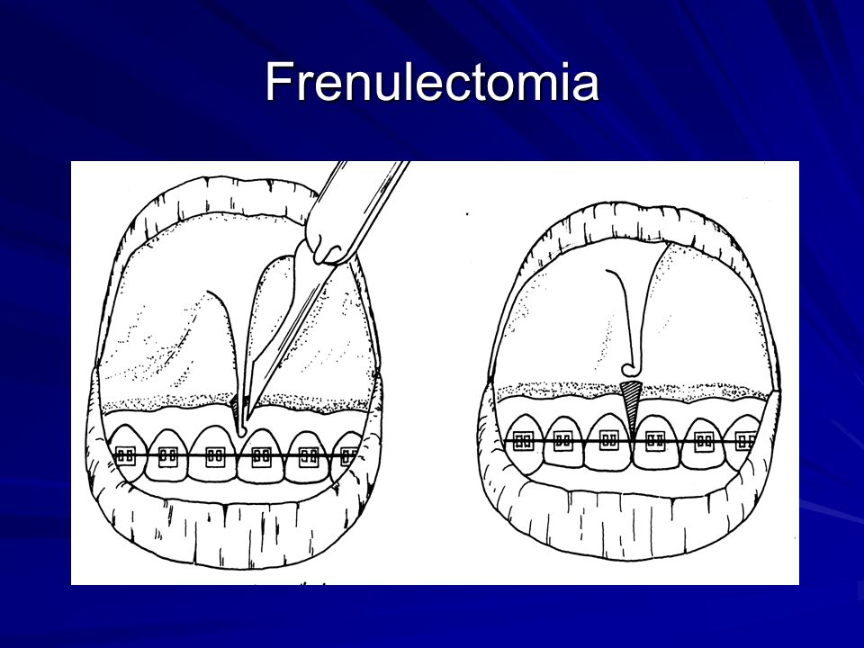 Frenulectomia