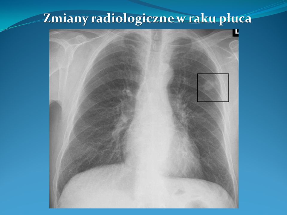 Zmiany radiologiczne w raku płuca