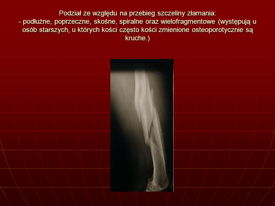 Podział ze względu na przebieg szczeliny złamania: - podłużne, poprzeczne, skośne, spiralne oraz wielofragmentowe (występują u osób starszych, u których kości często kości zmienione osteoporotycznie są kruche.)