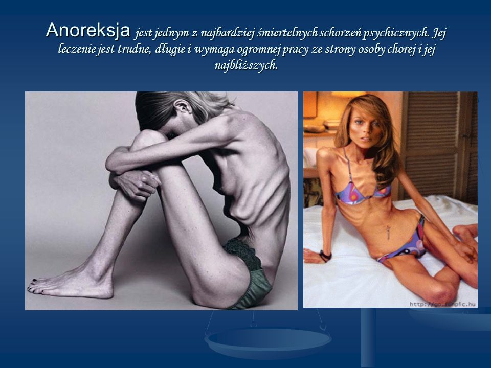 Anoreksja jest jednym z najbardziej śmiertelnych schorzeń psychicznych