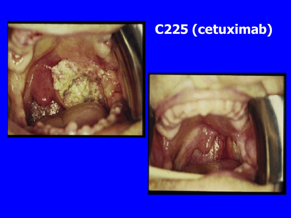 C225 (cetuximab)
