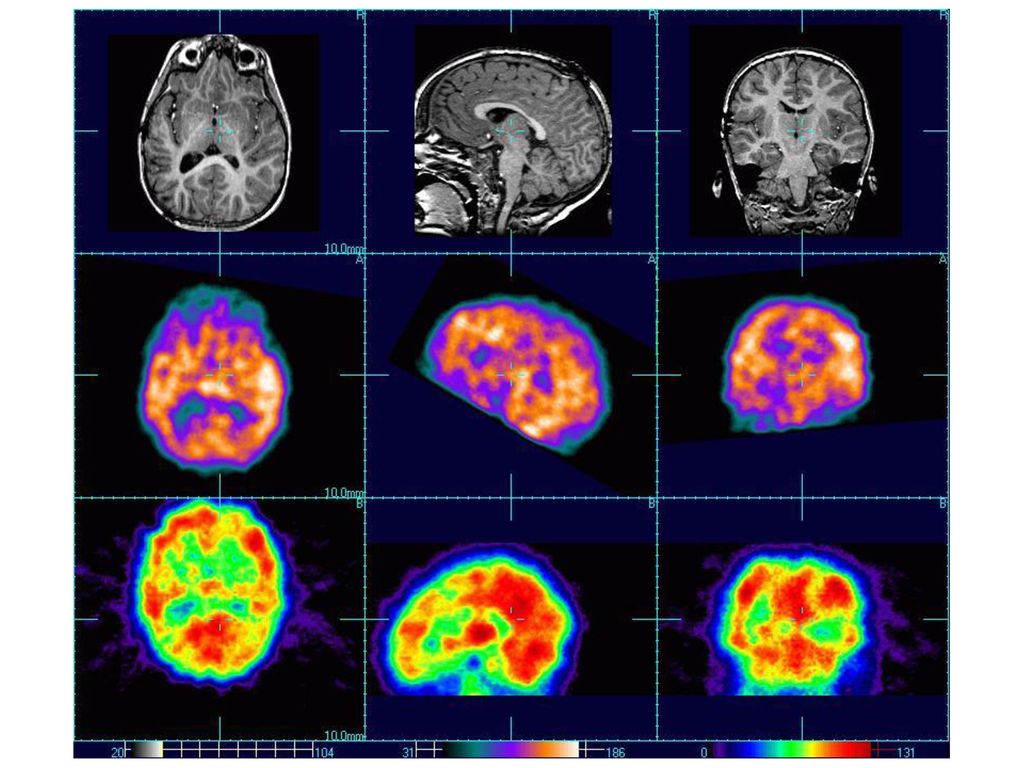 Восстановление деятельности головного мозга. Позитронно-эмиссионная томография головного мозга. Позитронно-эмиссионная томография мозга (ПЭТ). Однофотонная эмиссионная компьютерная томография головного мозга. Мрт, ПЭТ/кт, ОФЭКТ.