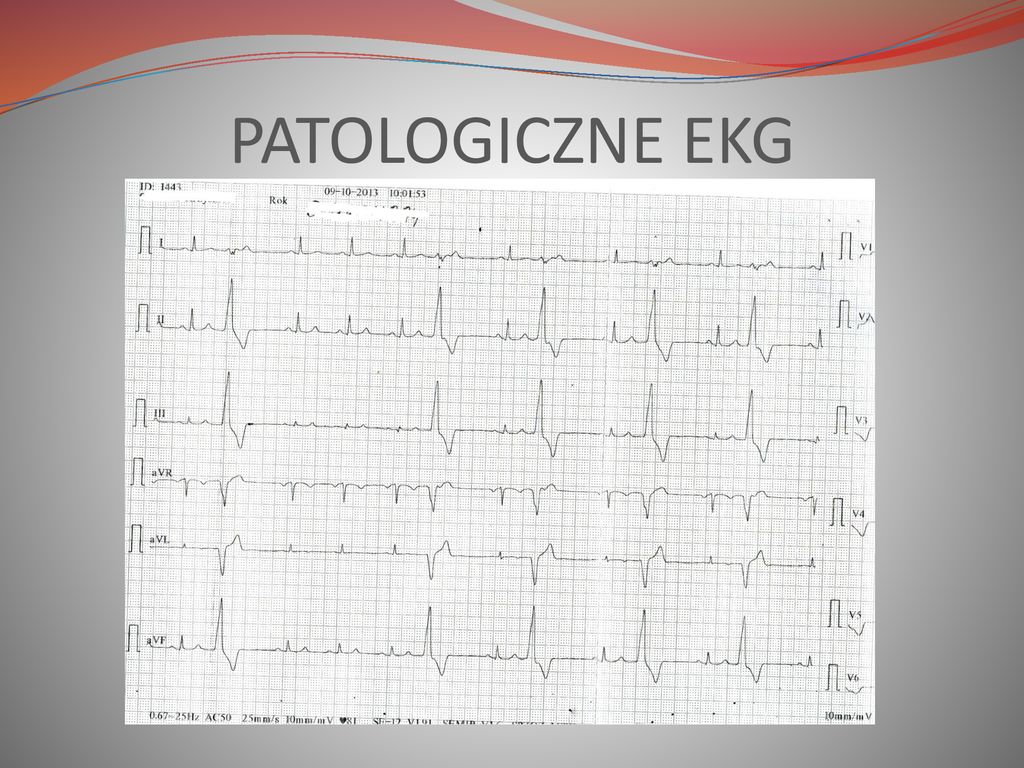 PATOLOGICZNE EKG