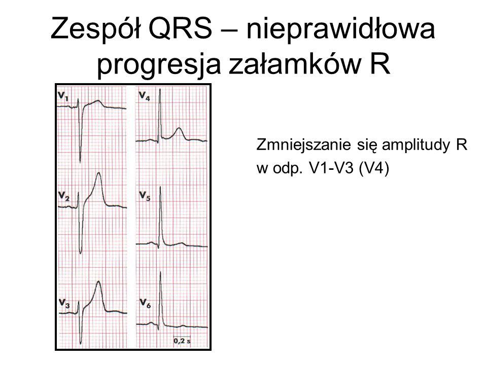 Zespół QRS – nieprawidłowa progresja załamków R