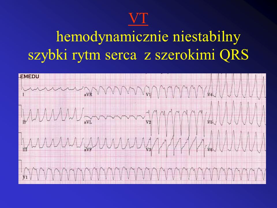 VT hemodynamicznie niestabilny szybki rytm serca z szerokimi QRS
