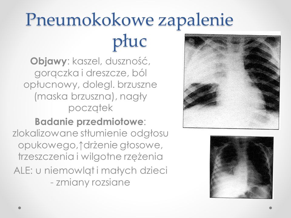 Pneumokokowe zapalenie płuc