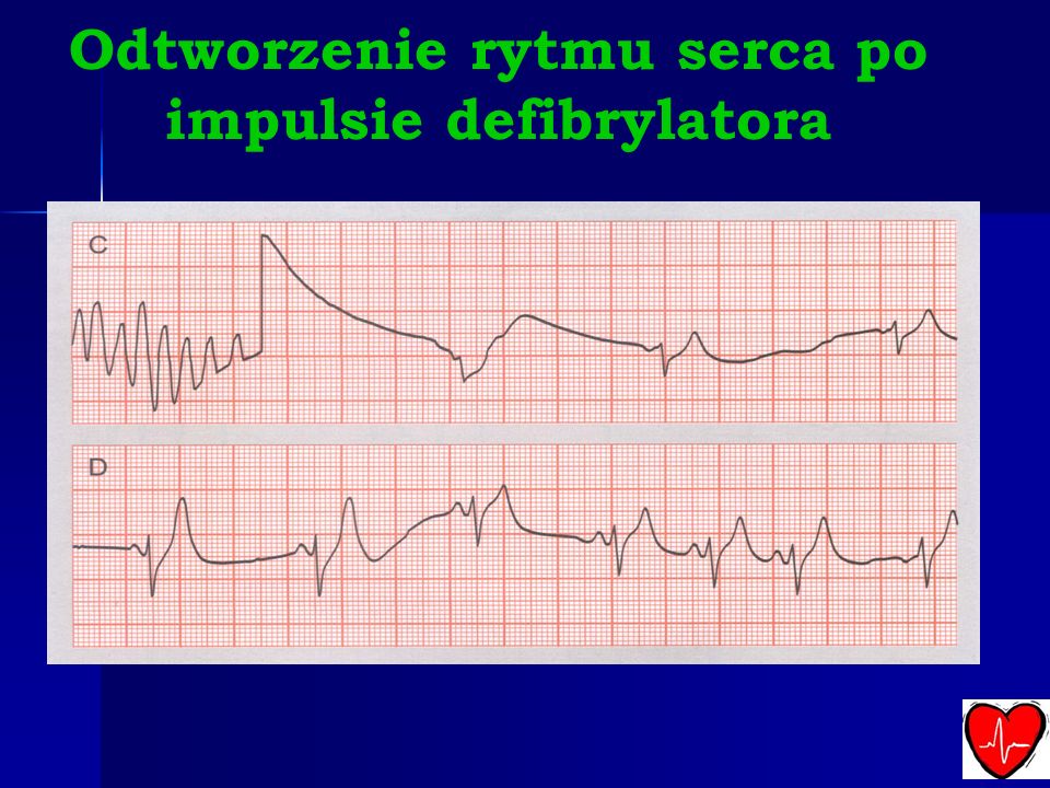 Odtworzenie rytmu serca po impulsie defibrylatora