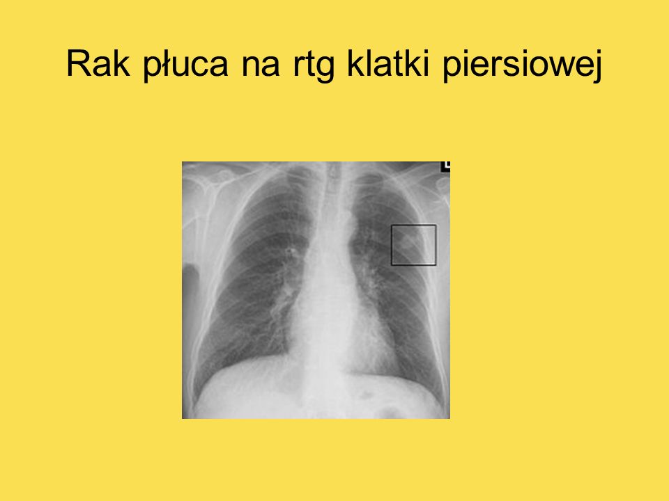 Rak płuca na rtg klatki piersiowej