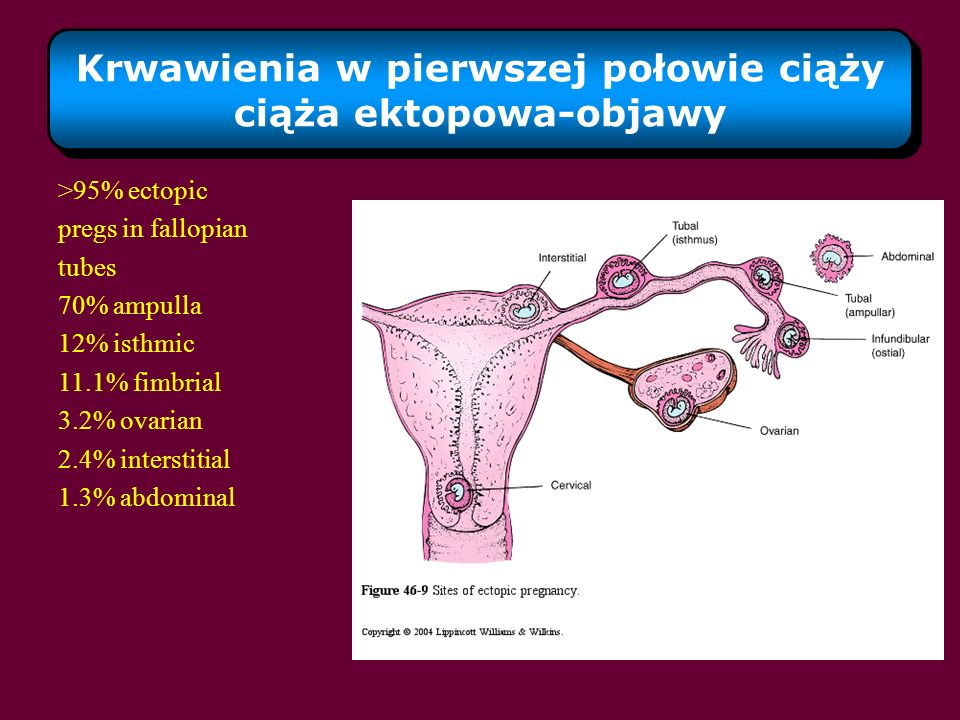 Krwawienia w pierwszej połowie ciąży ciąża ektopowa-objawy