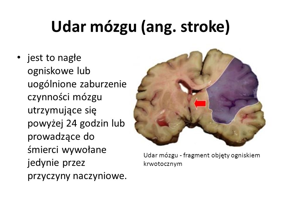 Udar mózgu (ang. stroke)