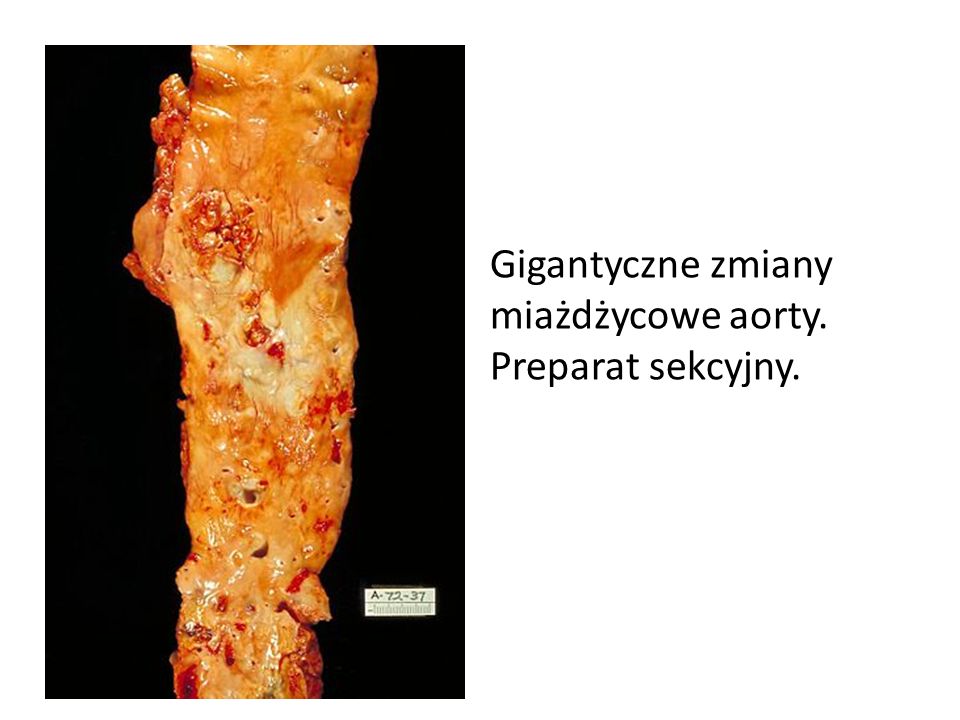 Gigantyczne zmiany miażdżycowe aorty. Preparat sekcyjny.