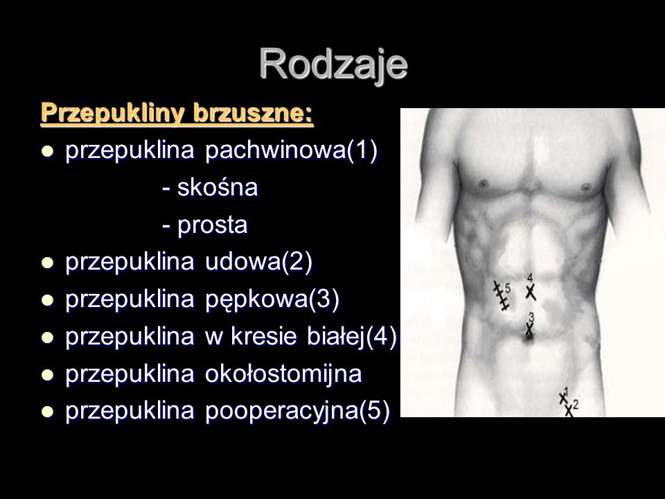 Przepuklina Pachwinowa Skośna Zdjęcia Polska Zdjecia