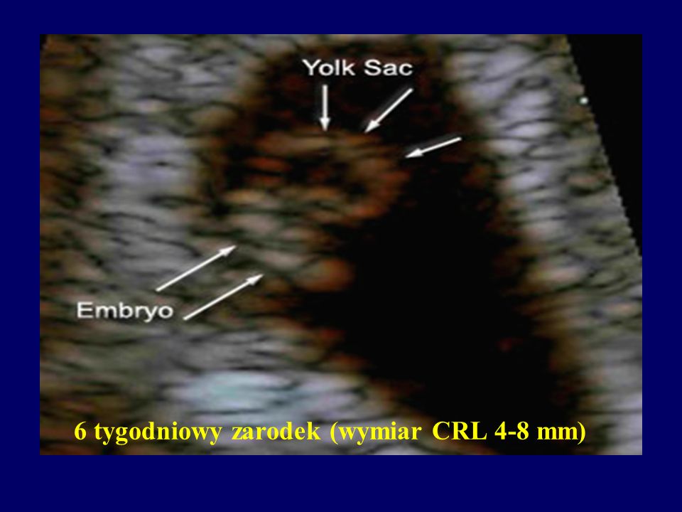 6 tygodniowy zarodek (wymiar CRL 4-8 mm)