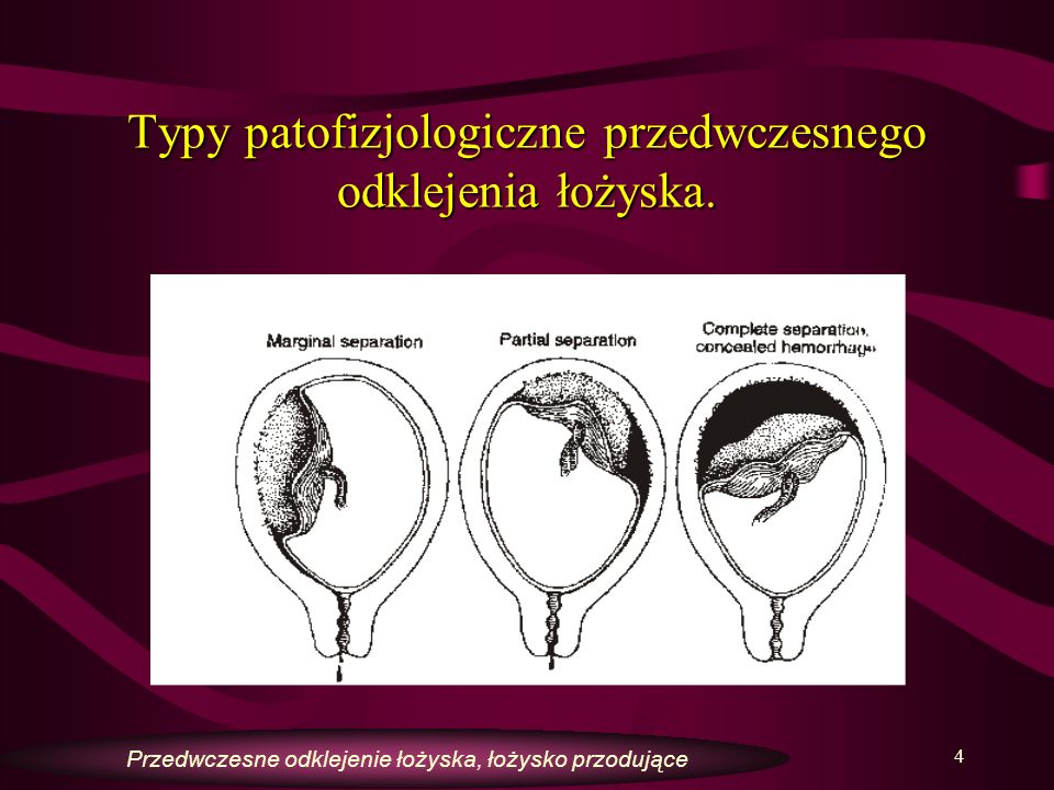 Typy patofizjologiczne przedwczesnego odklejenia łożyska.