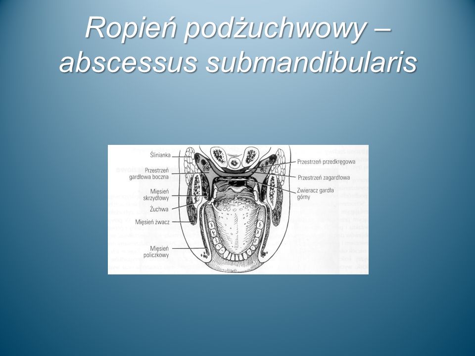 Ropień podżuchwowy – abscessus submandibularis
