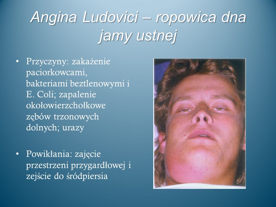 Angina Ludovici – ropowica dna jamy ustnej