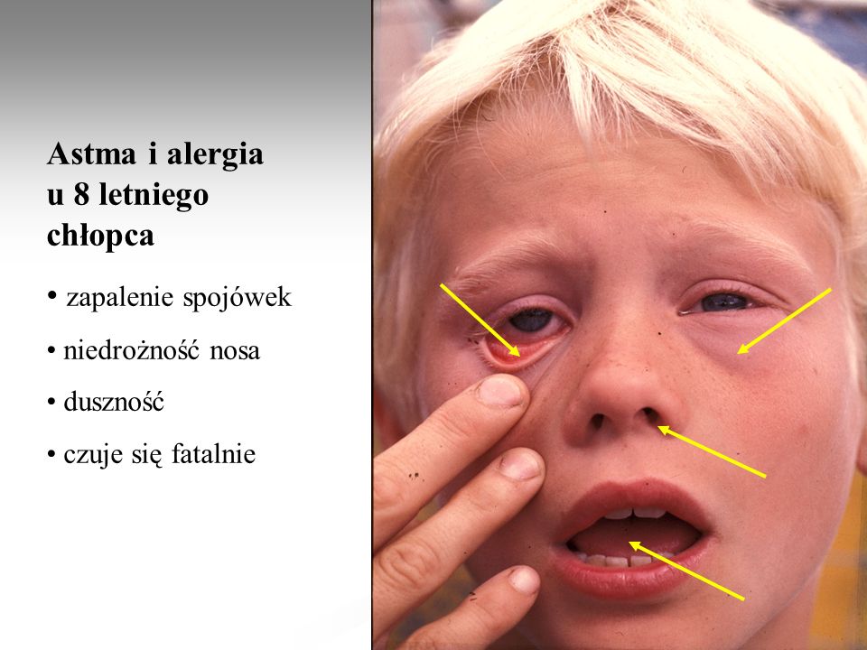 Astma i alergia u 8 letniego chłopca