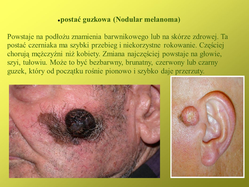 postać guzkowa (Nodular melanoma)