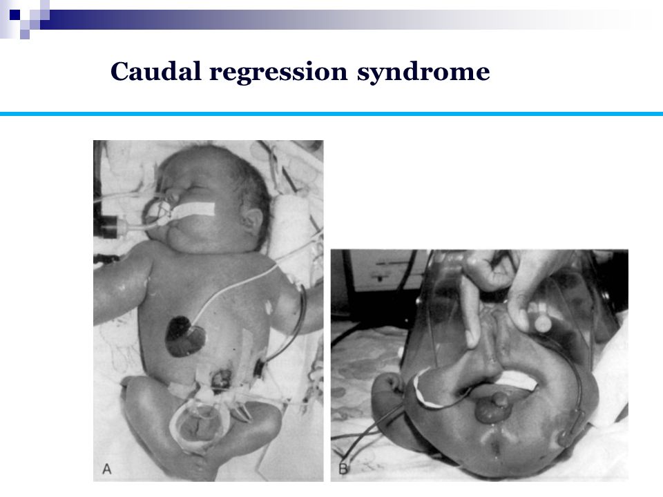 Caudal regression syndrome