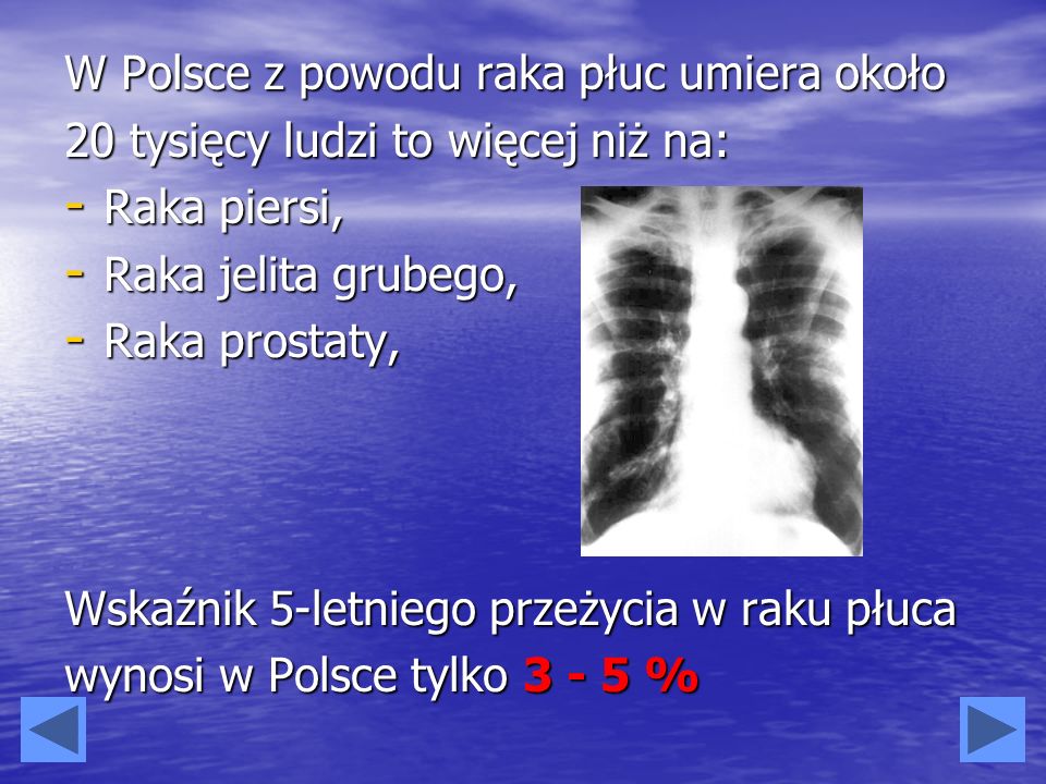 W Polsce z powodu raka płuc umiera około