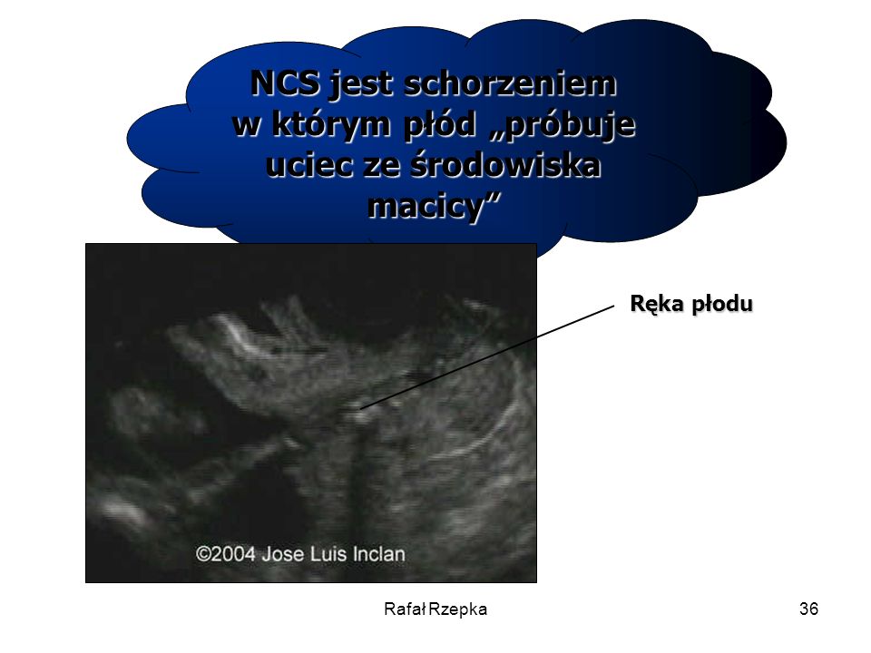 NCS jest schorzeniem w którym płód „próbuje uciec ze środowiska macicy