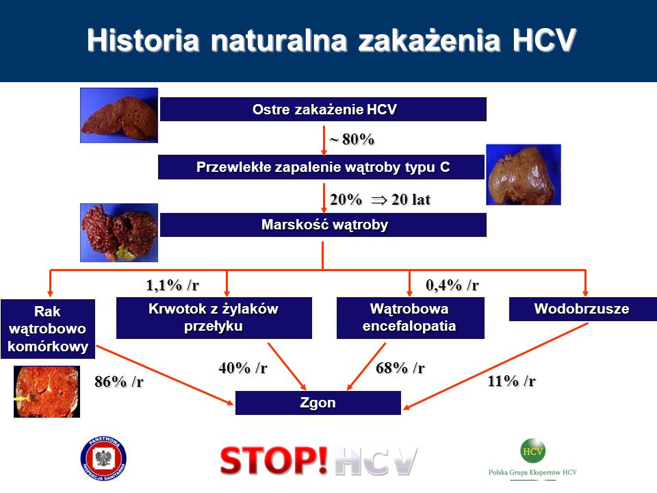 Historia naturalna zakażenia HCV