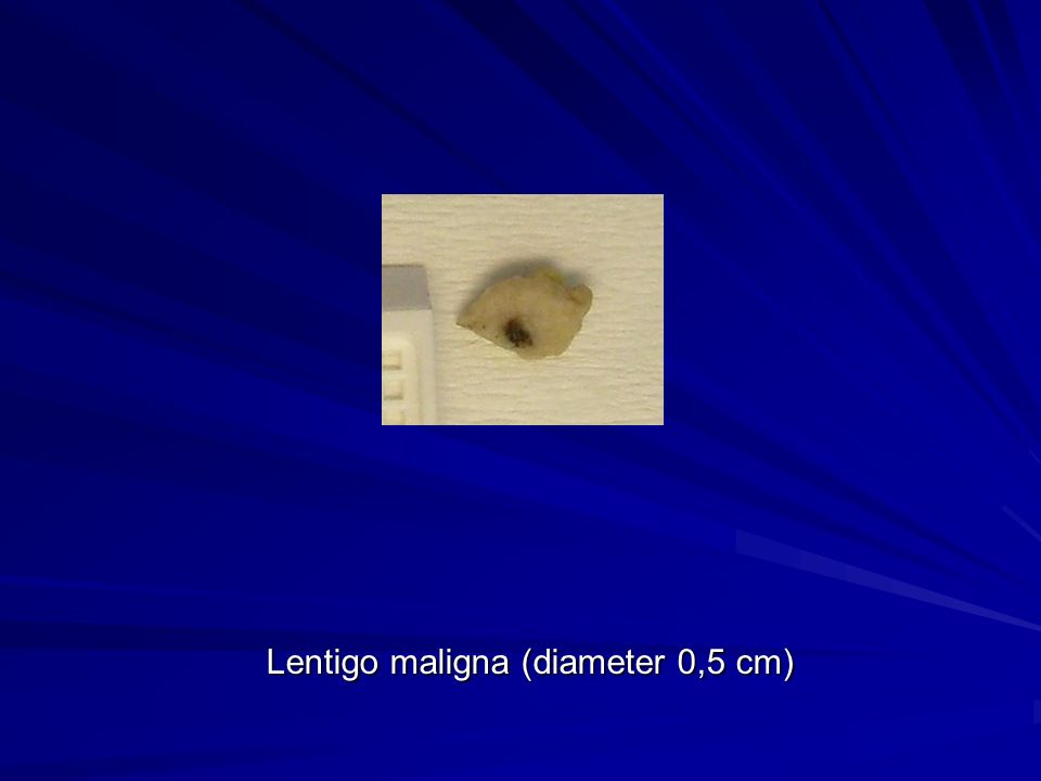 Lentigo maligna (diameter 0,5 cm)