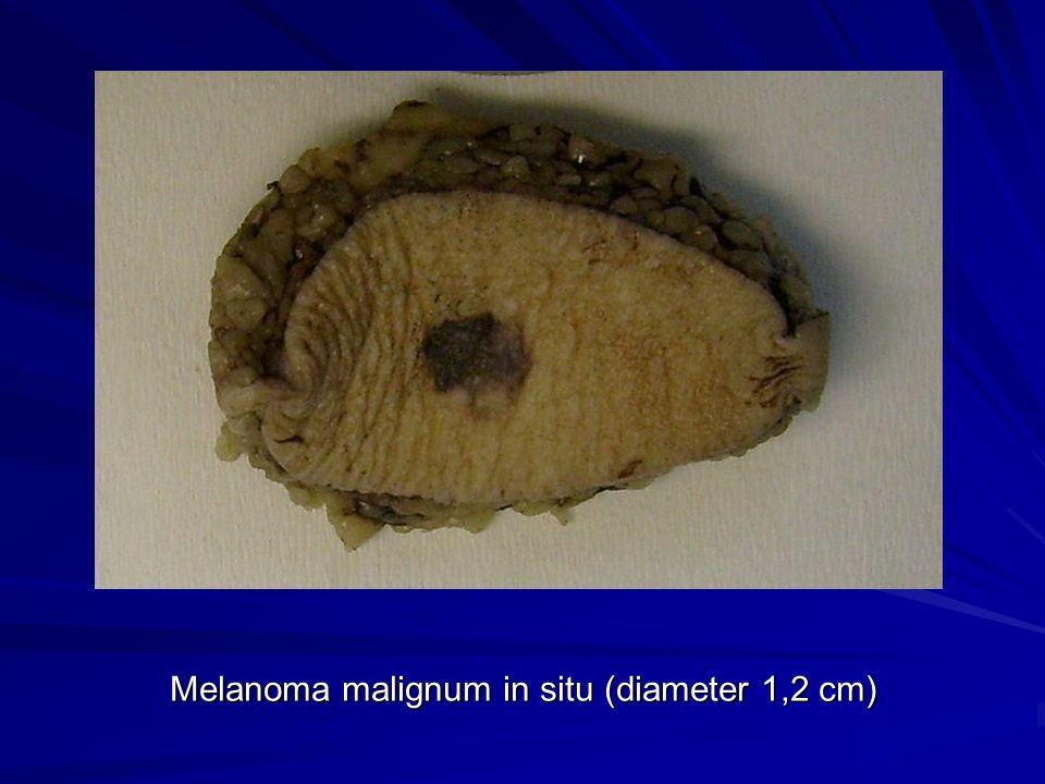 Melanoma malignum in situ (diameter 1,2 cm)