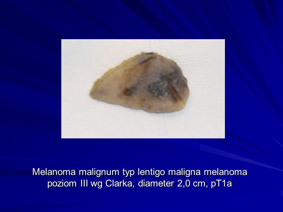 Melanoma malignum typ lentigo maligna melanoma poziom III wg Clarka, diameter 2,0 cm, pT1a