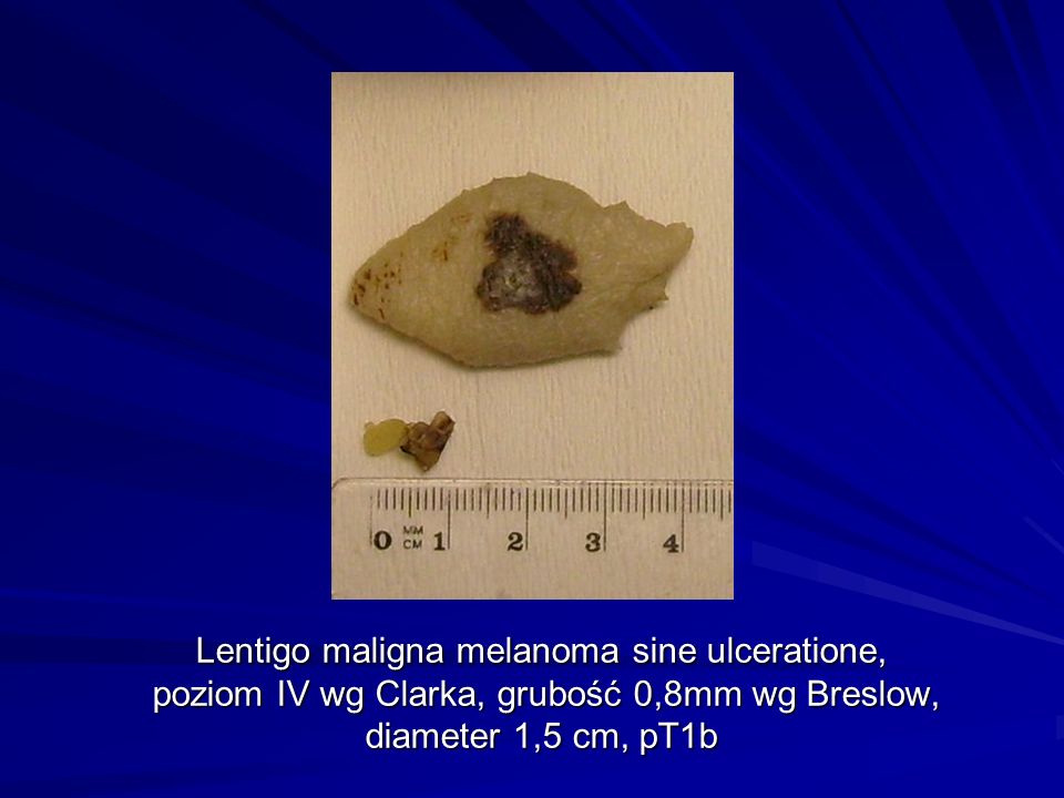 Lentigo maligna melanoma sine ulceratione, poziom IV wg Clarka, grubość 0,8mm wg Breslow, diameter 1,5 cm, pT1b