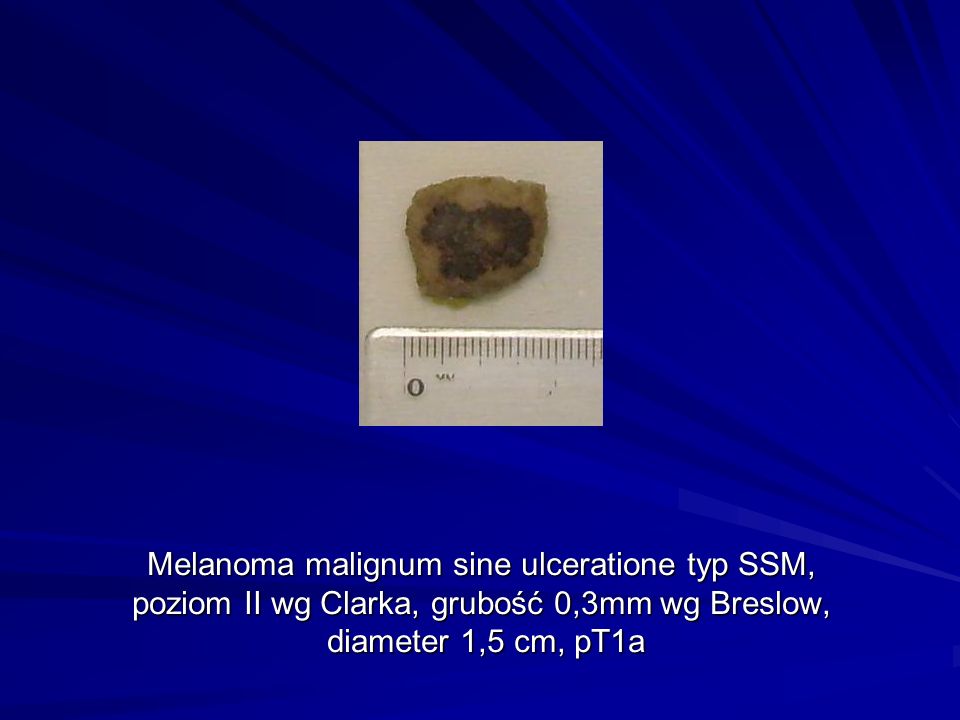 Melanoma malignum sine ulceratione typ SSM, poziom II wg Clarka, grubość 0,3mm wg Breslow, diameter 1,5 cm, pT1a