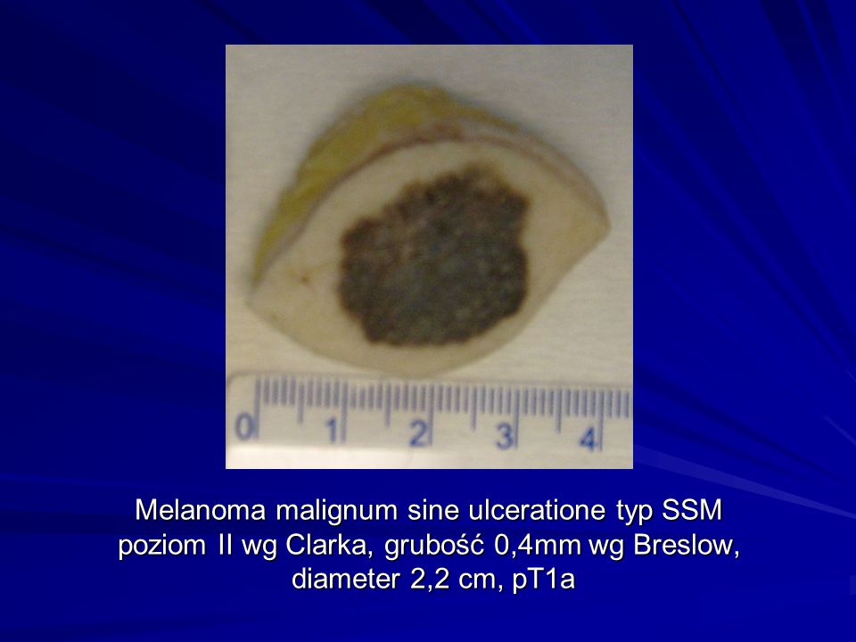 Melanoma malignum sine ulceratione typ SSM poziom II wg Clarka, grubość 0,4mm wg Breslow, diameter 2,2 cm, pT1a