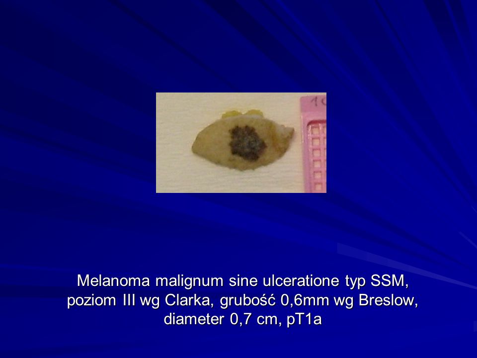 Melanoma malignum sine ulceratione typ SSM, poziom III wg Clarka, grubość 0,6mm wg Breslow, diameter 0,7 cm, pT1a