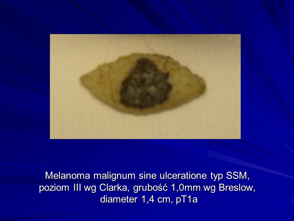 Melanoma malignum sine ulceratione typ SSM, poziom III wg Clarka, grubość 1,0mm wg Breslow, diameter 1,4 cm, pT1a