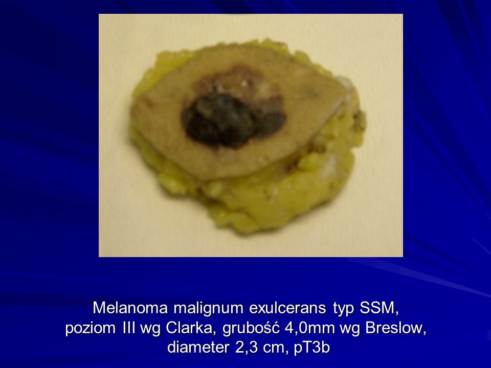 Melanoma malignum exulcerans typ SSM, poziom III wg Clarka, grubość 4,0mm wg Breslow, diameter 2,3 cm, pT3b
