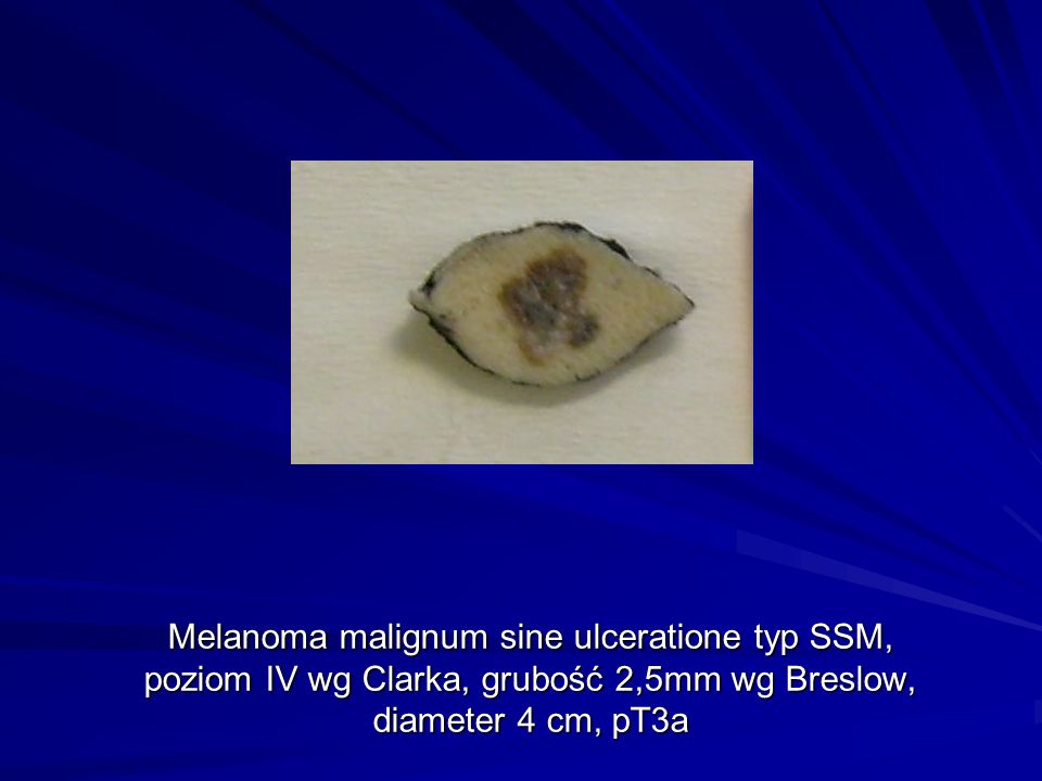 Melanoma malignum sine ulceratione typ SSM, poziom IV wg Clarka, grubość 2,5mm wg Breslow, diameter 4 cm, pT3a