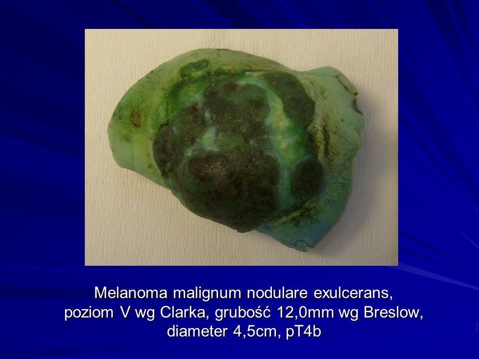 Melanoma malignum nodulare exulcerans, poziom V wg Clarka, grubość 12,0mm wg Breslow, diameter 4,5cm, pT4b