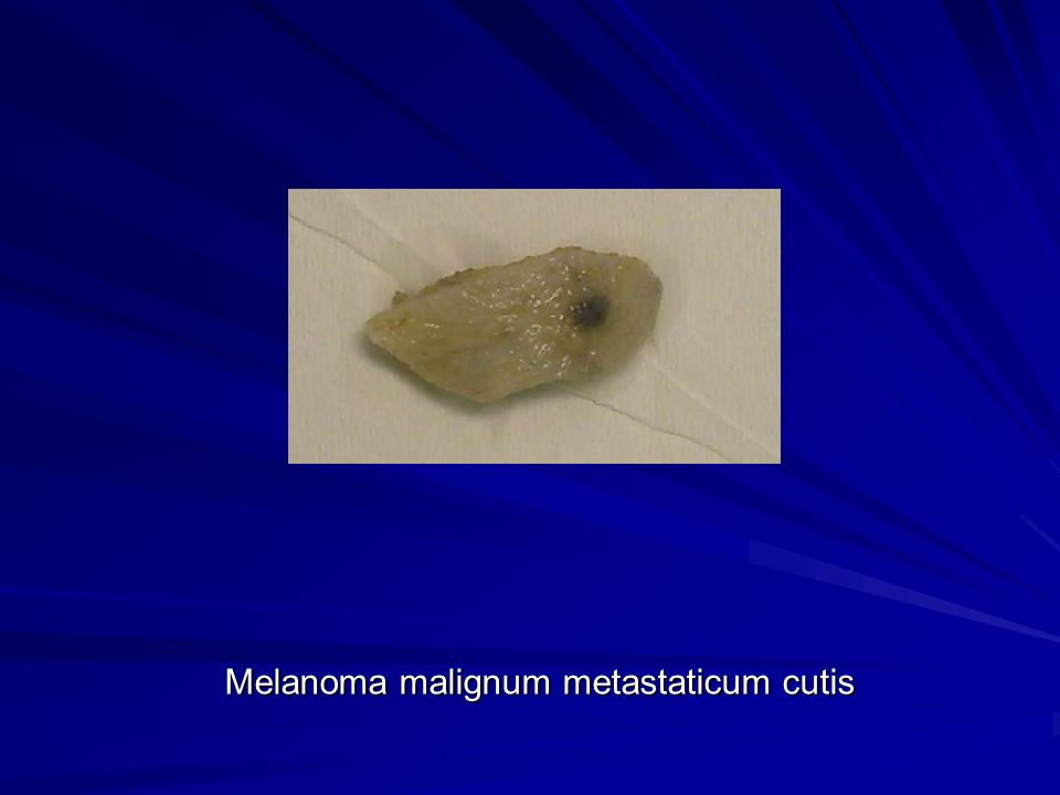 Melanoma malignum metastaticum cutis