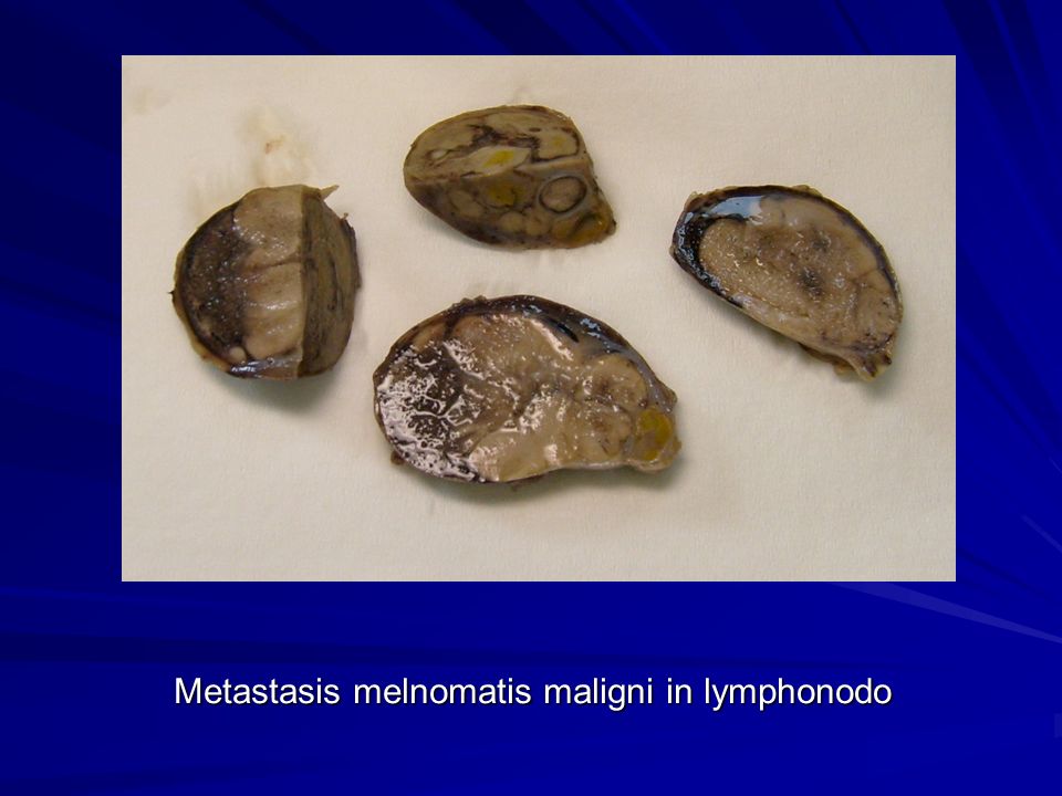 Metastasis melnomatis maligni in lymphonodo