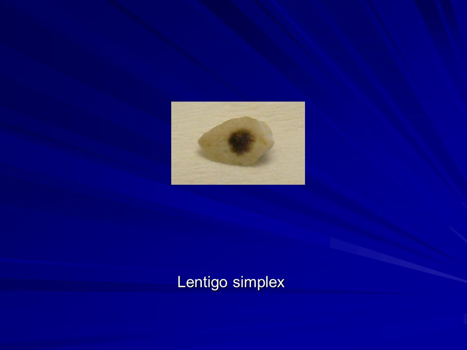 Lentigo simplex