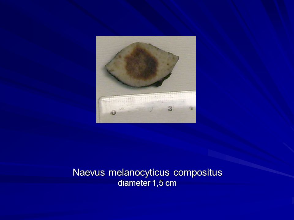 Naevus melanocyticus compositus diameter 1,5 cm